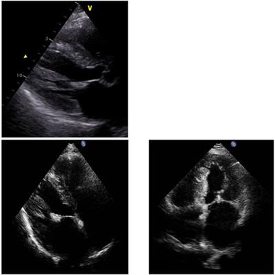 Case report: Magnetocardiography as a potential method of therapy monitoring in amyloidosis